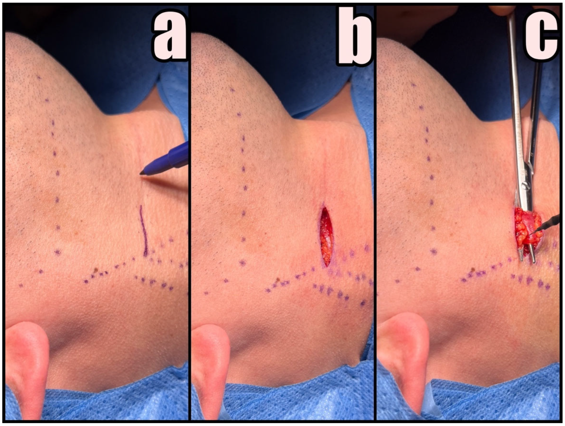 a, b, c. A. Marking of the incision containing the pilonidal cyst and 2