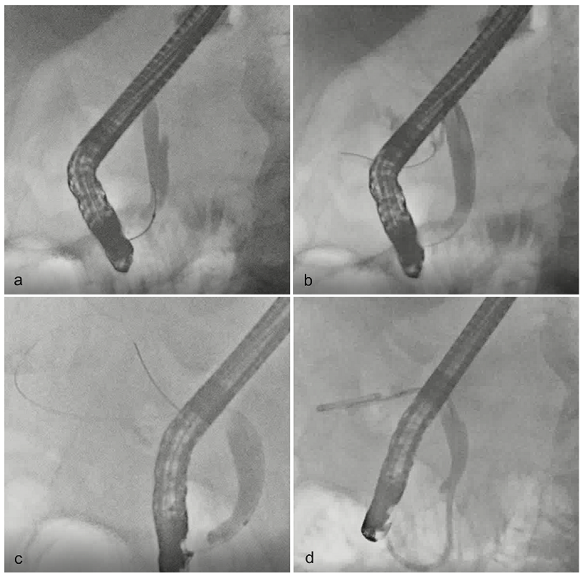 Strategy Comparison of Endoscopic UltrasoundGuided Gallbladder