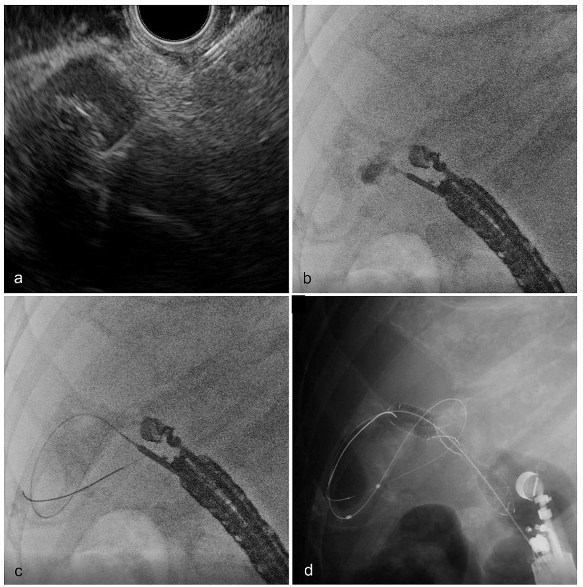 Strategy Comparison of Endoscopic UltrasoundGuided Gallbladder