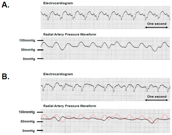 Impact of sex on clinical, procedural characteristics and outcomes of  catheter ablation for ventricular arrhythmias according to underlying heart  disease