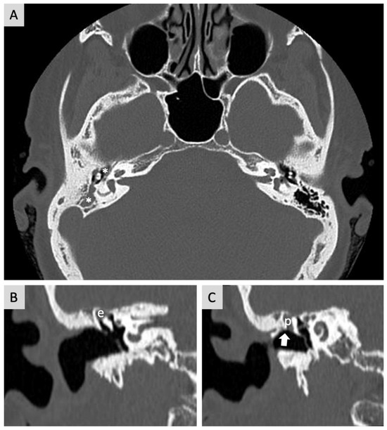 JCM Free FullText Middle Ear Cholesteatoma and Vestibular Schwannoma Resection Followed by