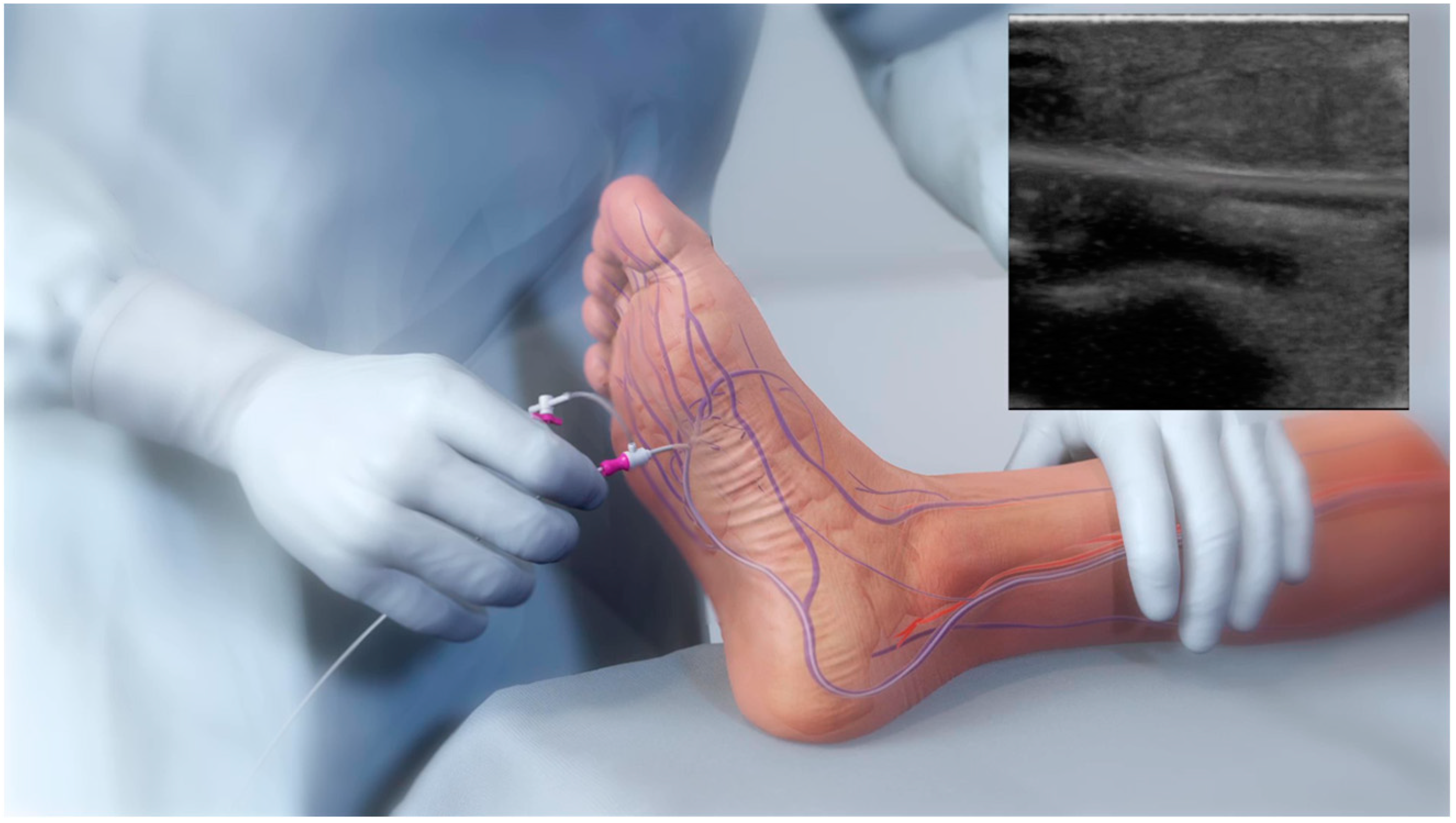 Hybrid superficial venous arterialization and endovascular deep venous  arterialization - Journal of Vascular Surgery Cases, Innovations and  Techniques