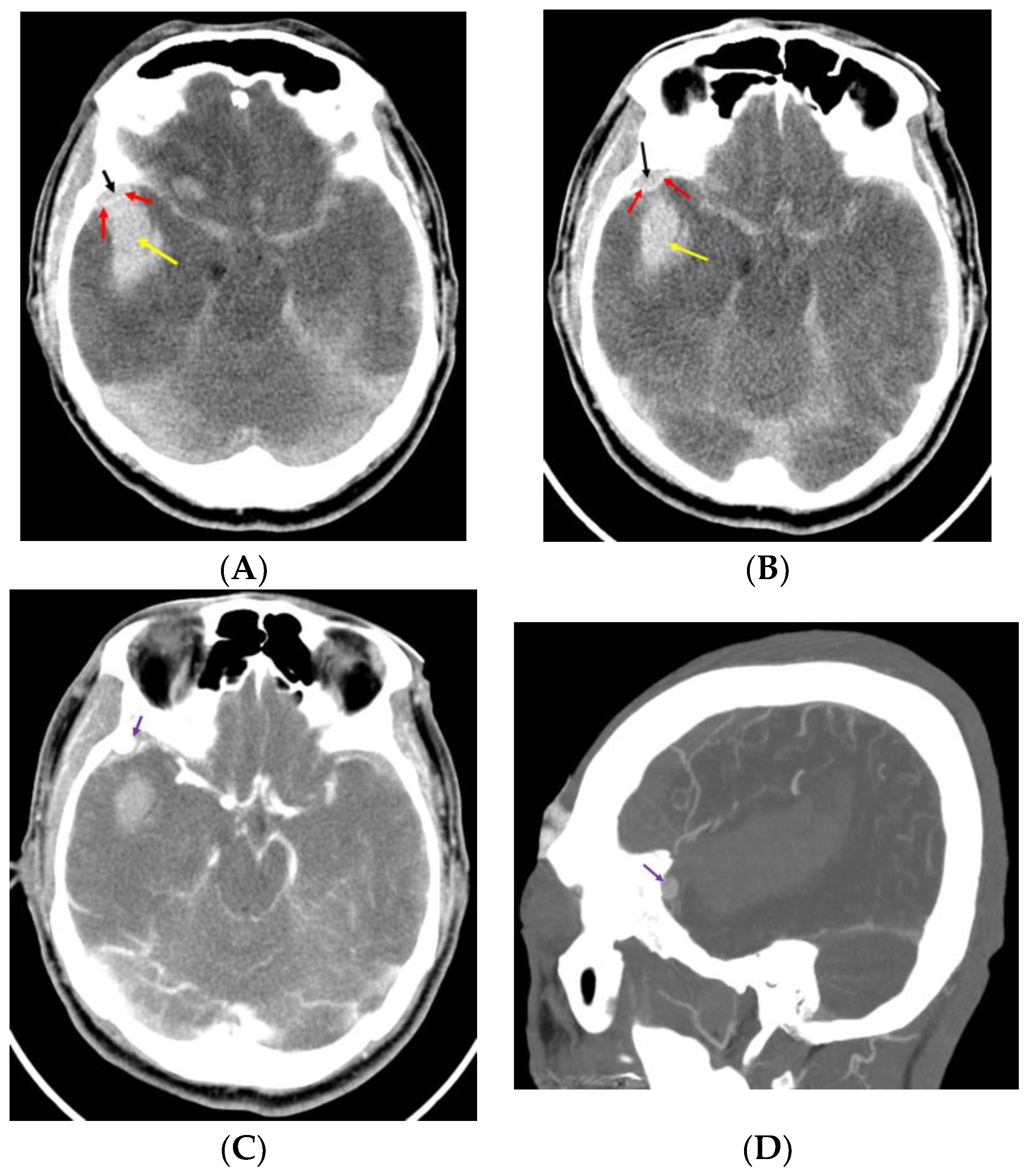 JCM | Free Full-Text | Intracerebral Hemorrhage Caused by the Rupture ...