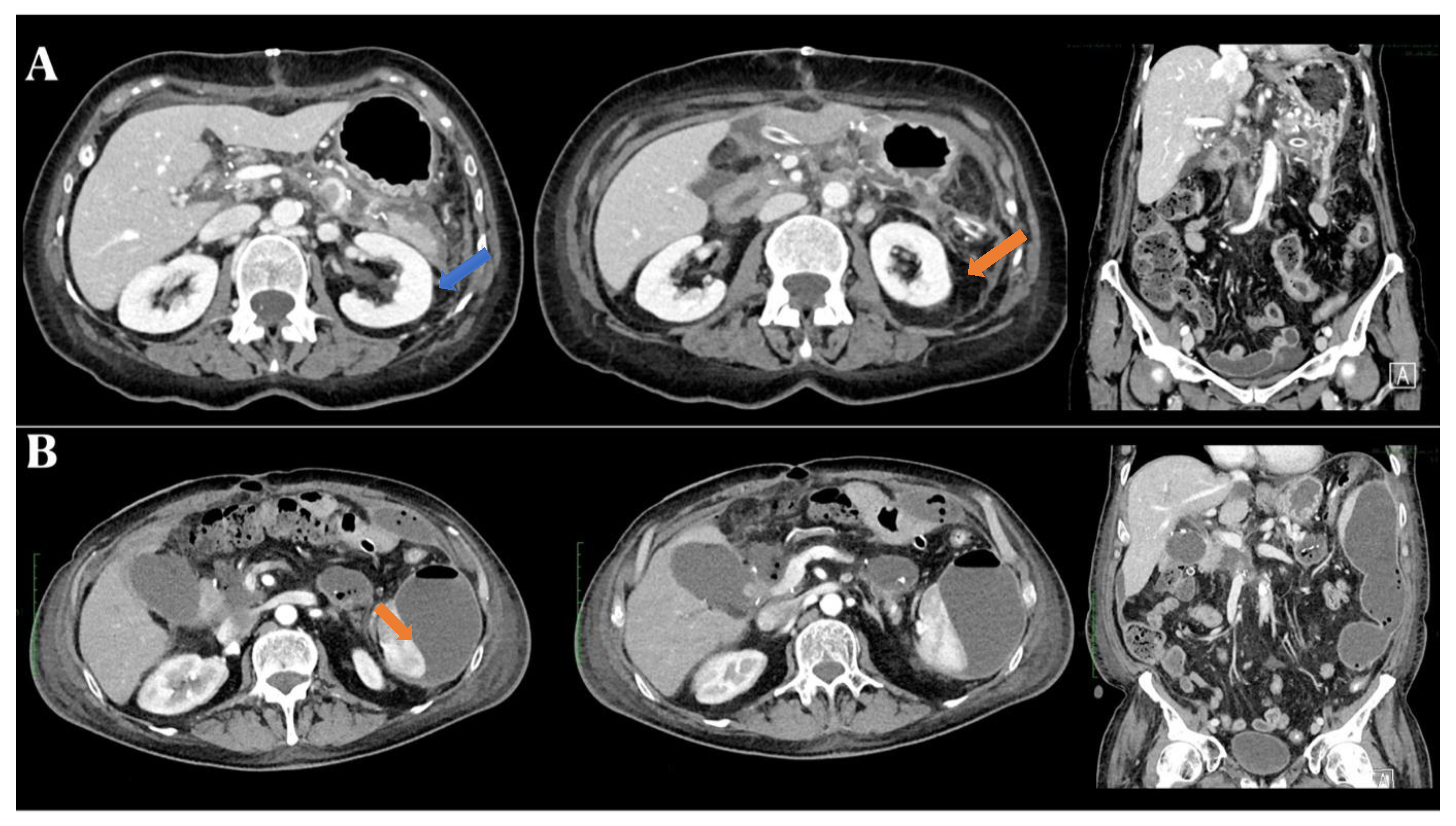 Mani Megalai Sex Videos - JCM | Free Full-Text | Pancreatic Ductal Adenocarcinoma: Update of CT-Based  Radiomics Applications in the Pre-Surgical Prediction of the Risk of  Post-Operative Fistula, Resectability Status and Prognosis