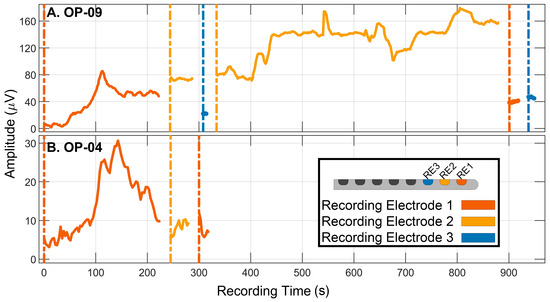 Evaluation of Real-Time Intracochlear Electrocochleography for Guiding ...