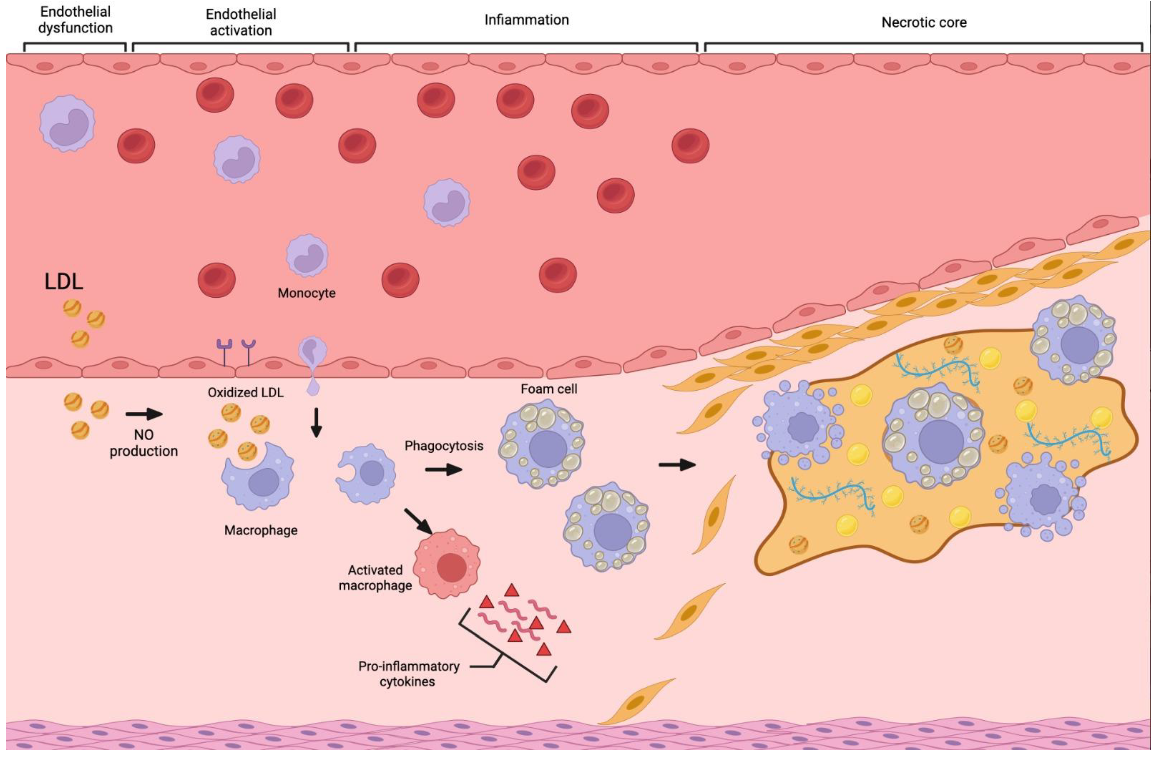 Histopathology of colorectal adenocarcinoma - Wikipedia