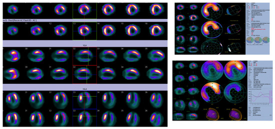 Multimodality Imaging in Advanced Heart Failure for Diagnosis ...