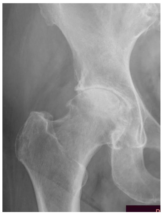 JCM Free FullText Level of Disability after Total Hip Replacement in Patients with Some