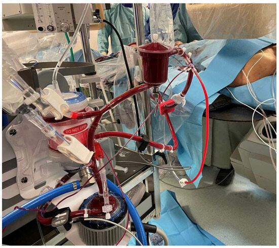 Emergent Conversion to Open Heart Surgery during Transcatheter 