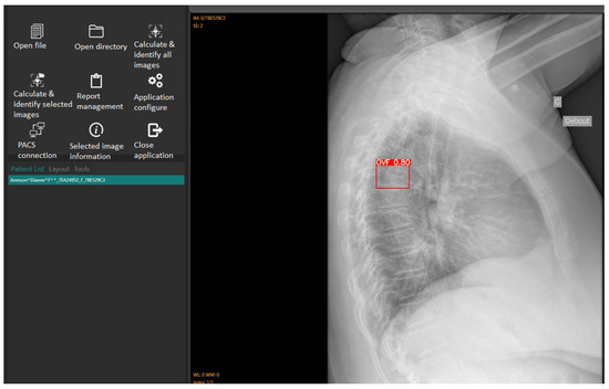 Artificial Intelligence-Assisted Detection of Osteoporotic 