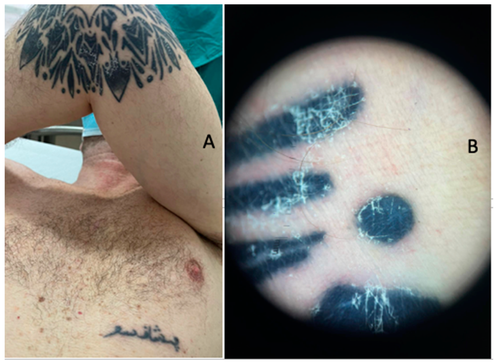 JCM | Free Full-Text | Tattoo-Associated Skin Reaction in a Melanoma  Patient Receiving B-RAF and MEK Inhibitors: A Case Report with an Emphasis  on Etiopathogenic and Histological Features