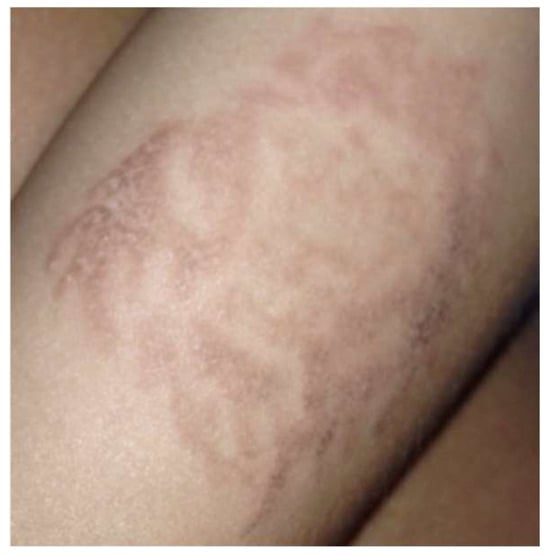 Red rash on breast (pic included) - Breastfeeding, Forums