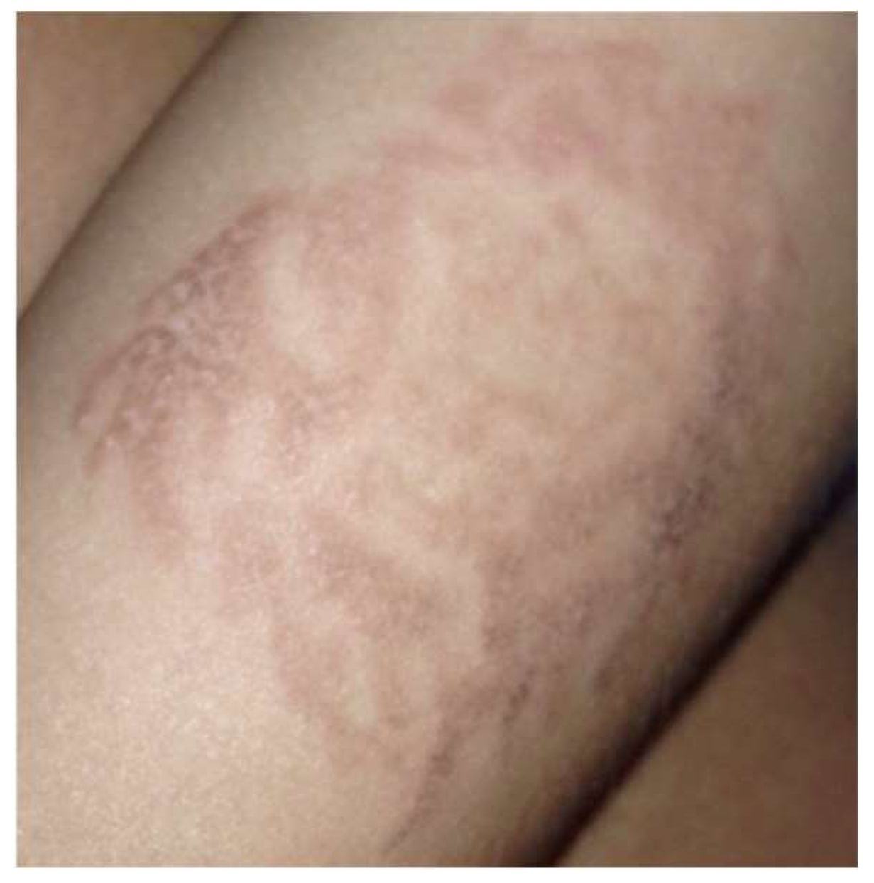Dark Spots/Scars on Legs,Immediately After Just 1 Session.Special