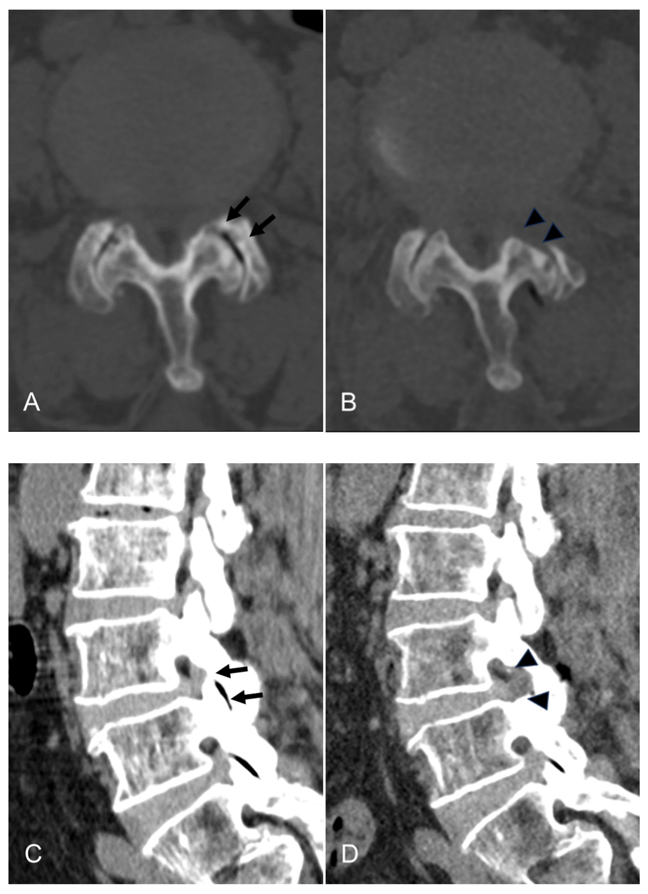 JCM Free FullText Transforaminal Endoscopic Lumbar Lateral Recess