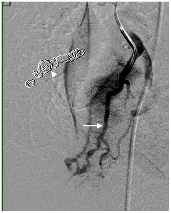 Embolization of De Novo Pulmonary Arteriovenous Malformations 