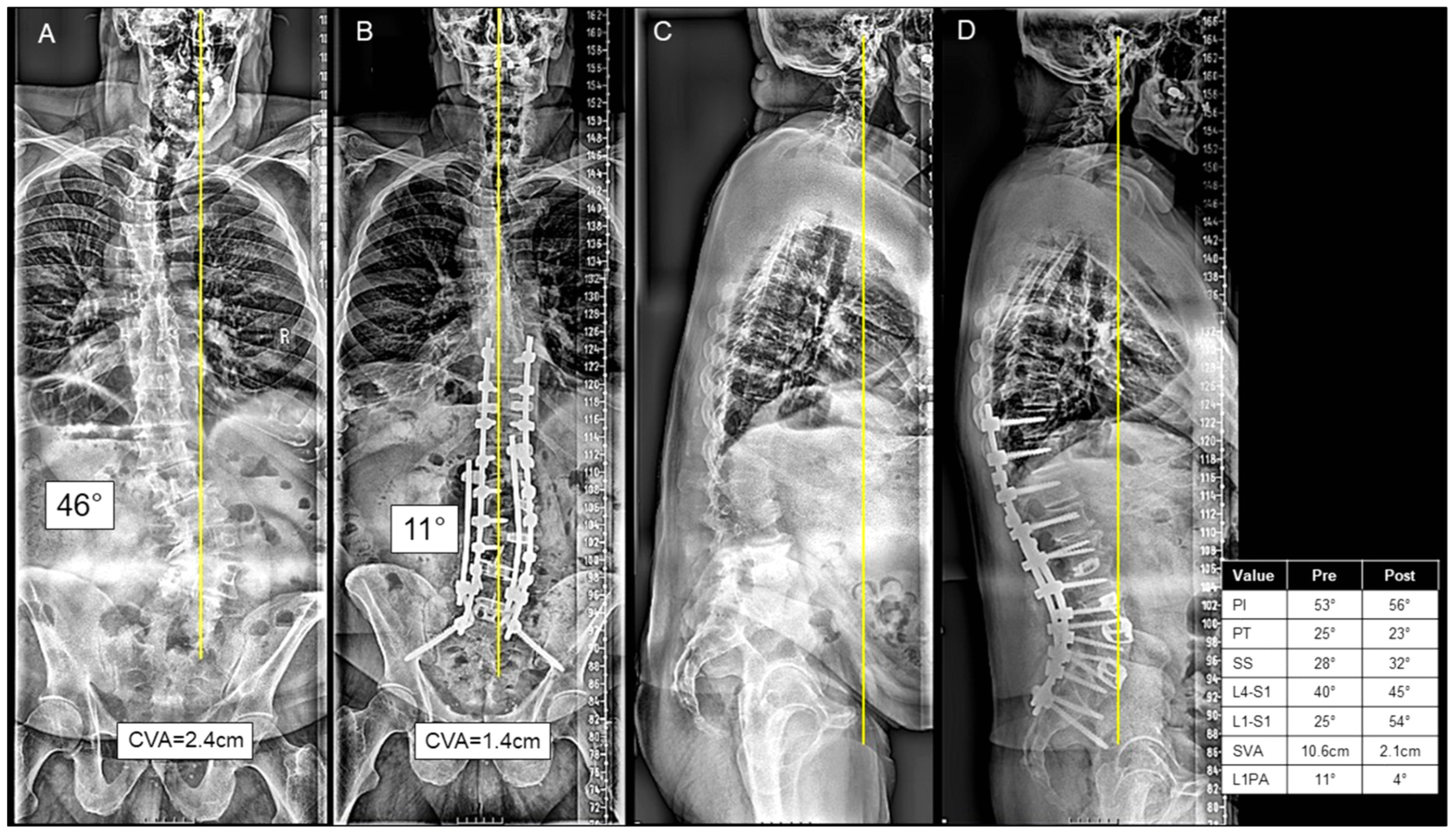 裁断済　脊椎脊髄病学 = PRINCIPLES OF SPINAL DISOR Cervicodorsal spine tuberculosis-- surgical approach