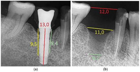 Management of Advanced Peri-Implantitis by Guided Bone