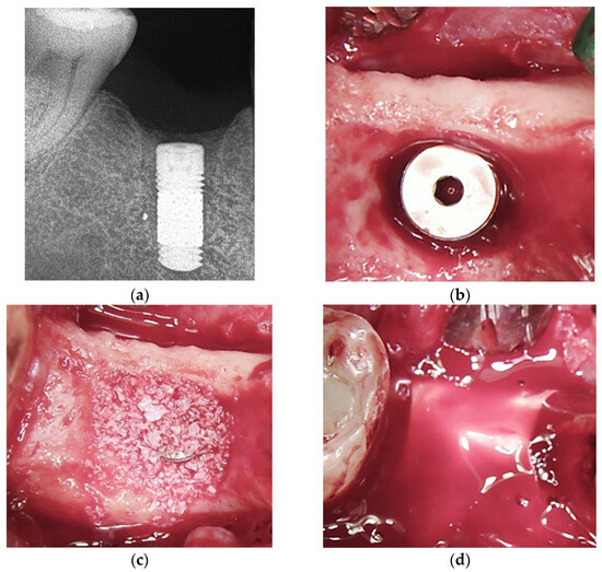 Zero Peri-implantitis Concept インプラント周囲炎 インプラント周囲炎ゼロコンセプト - クインテッセンス出版