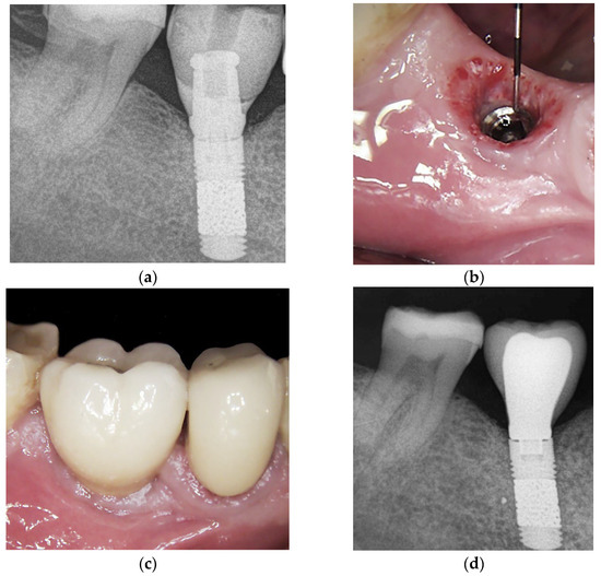 Management of Advanced Peri-Implantitis by Guided Bone