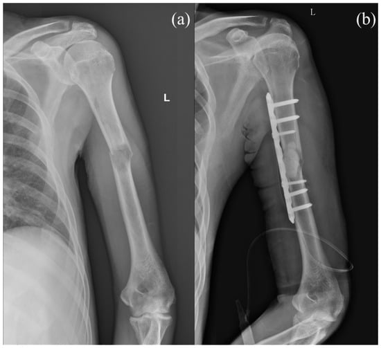 Alternative and off-label use of Titanium Elastic Nail® in acute adult  humeral diaphyseal and subcapital fractures - ScienceDirect