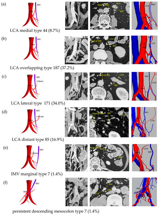 The Atlas of the Inferior Mesenteric Artery and Vein under The Atlas of the Inferior Mesenteric Artery and Vein under
