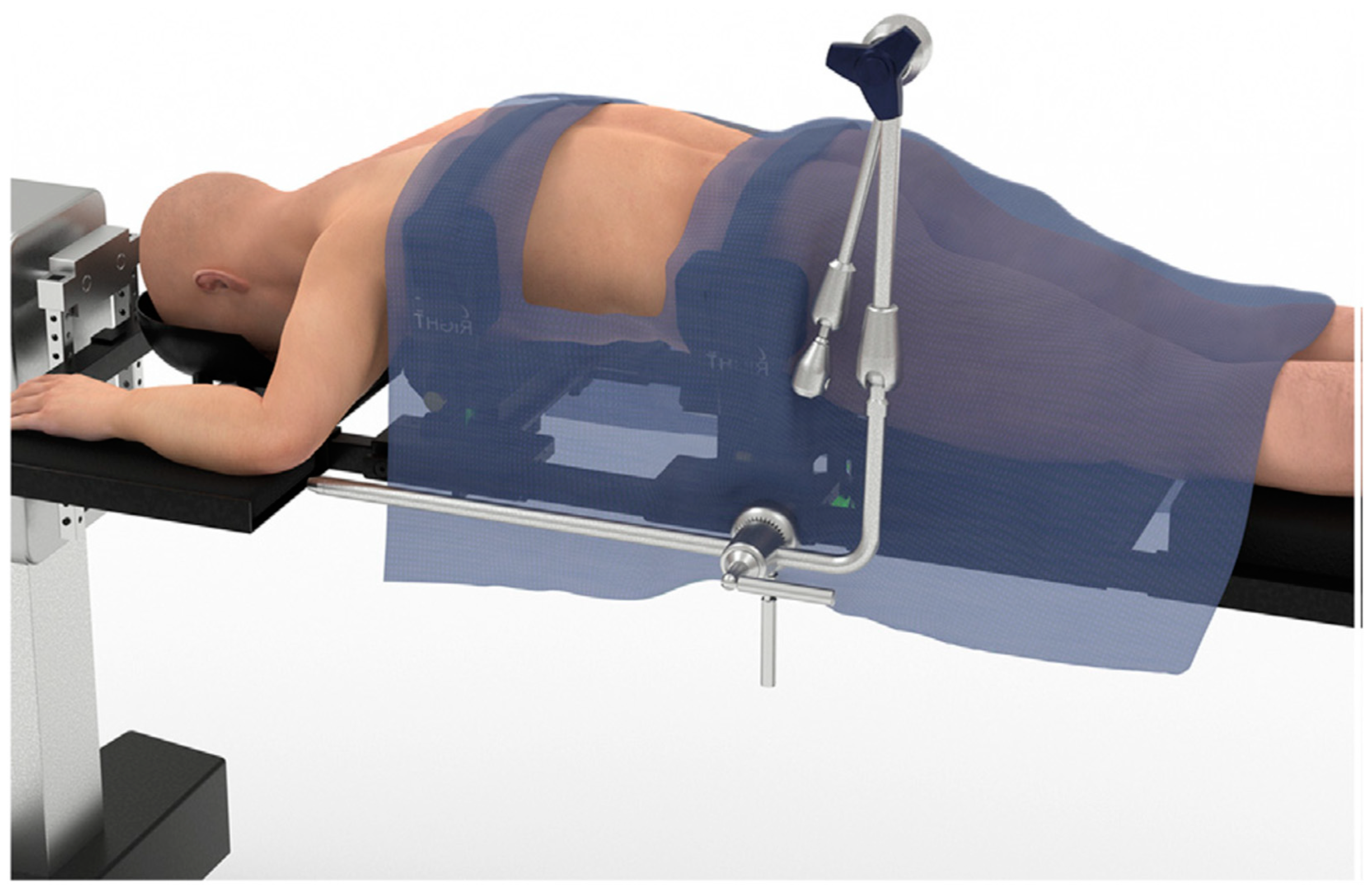 Advancing Prone-Transpsoas Spine Surgery: A Narrative Review