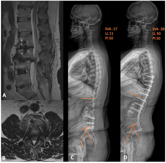 脊椎脊髄の手術 = Illustrated Surgery of Spine … Advancing Prone-Transpsoas Spine Surgery: A Narrative Review