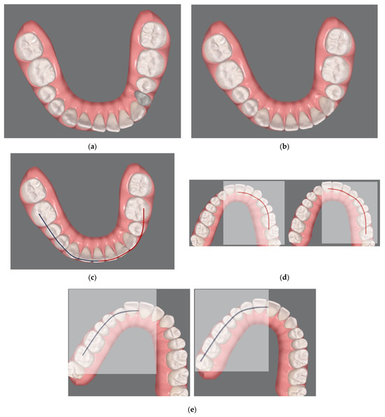 The Use of Clear Aligners in Multi-Segmental Maxillary Surgery: A
