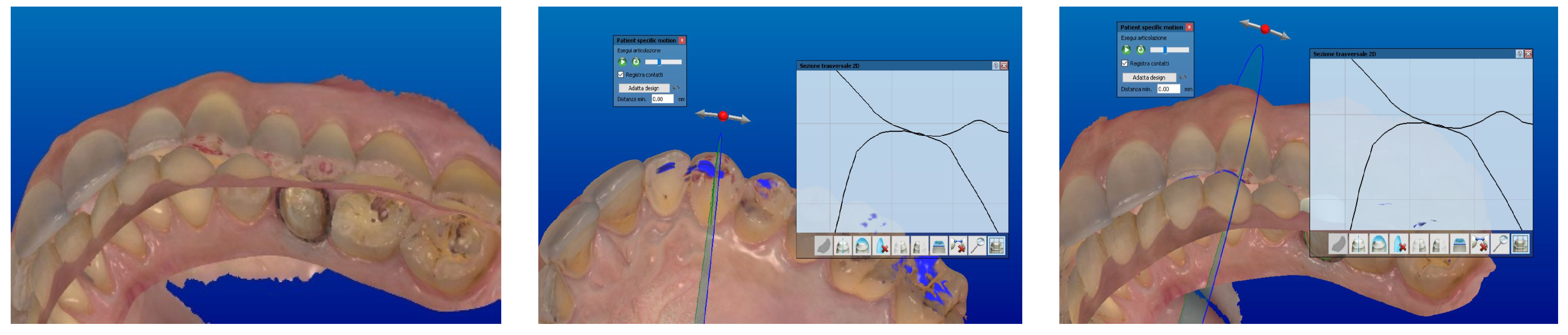 JCM Free FullText Digital Protocol to Record Occlusal Analysis in