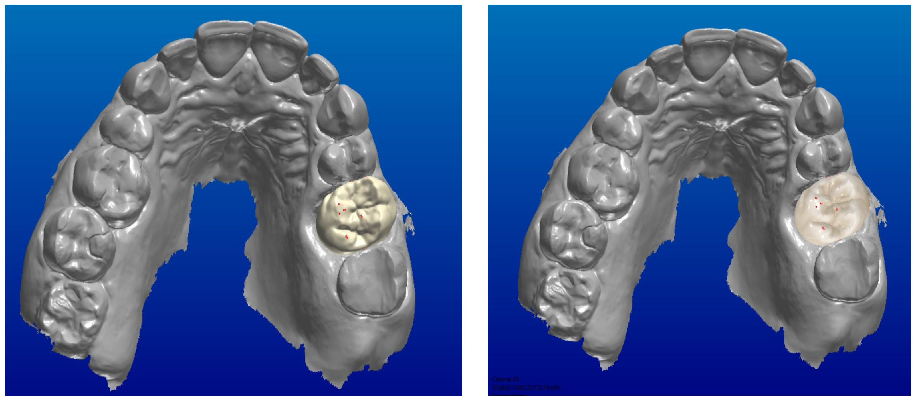 Digital Protocol to Record Occlusal Analysis in