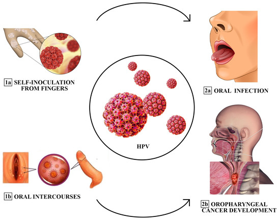 Analogies between HPV Behavior in Oral and Vaginal Cavity: Narrative Review  on the Current Evidence in the Literature