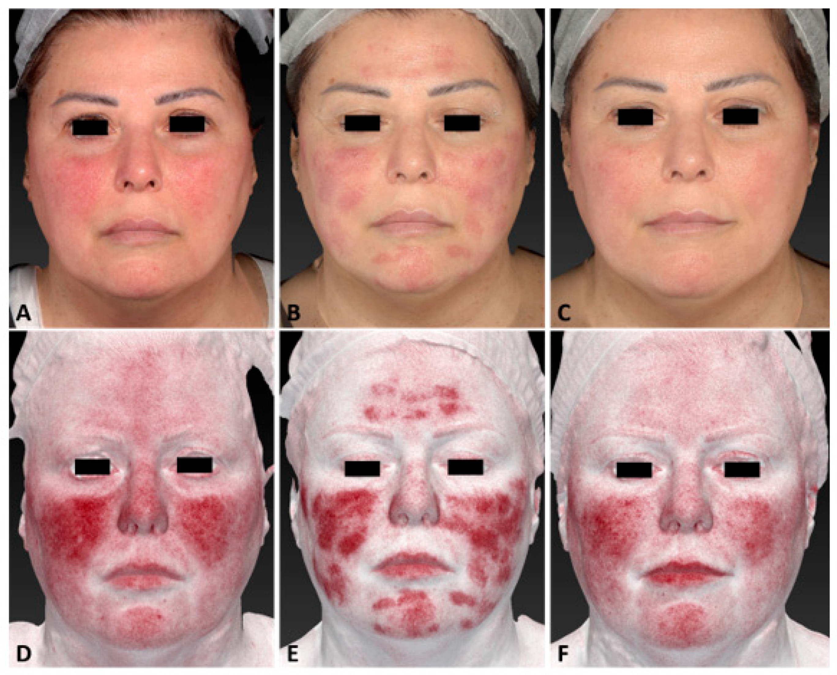 Ipl for rosacea hotsell