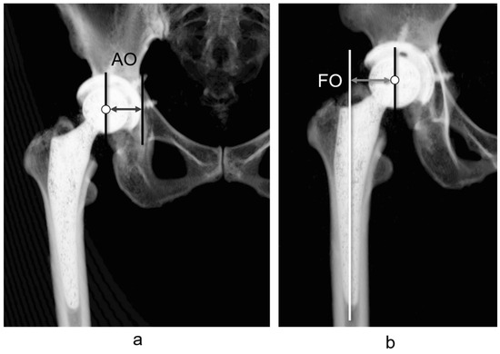 The Sum of the Leg Length Discrepancy and the Difference in