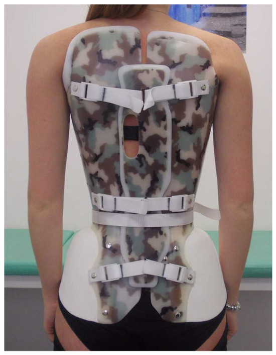The New Modular Sforzesco Brace (Modular Italian Brace) Is as Effective ...