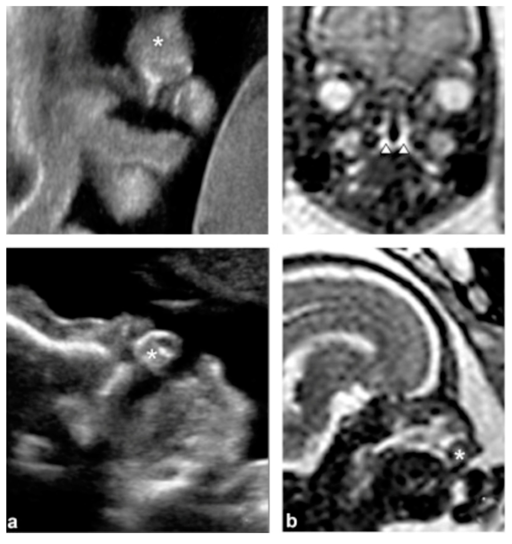 Cleft palate 2d ultrasound taiwan infoupdate