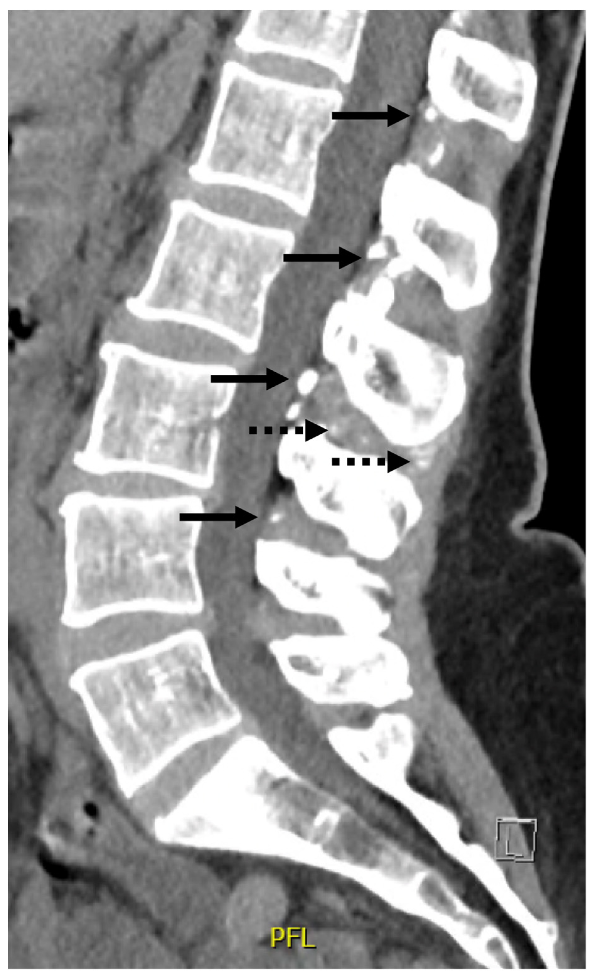 Hypophosphatasia Presenting as a Chronic Diffuse Pain Syndrome 