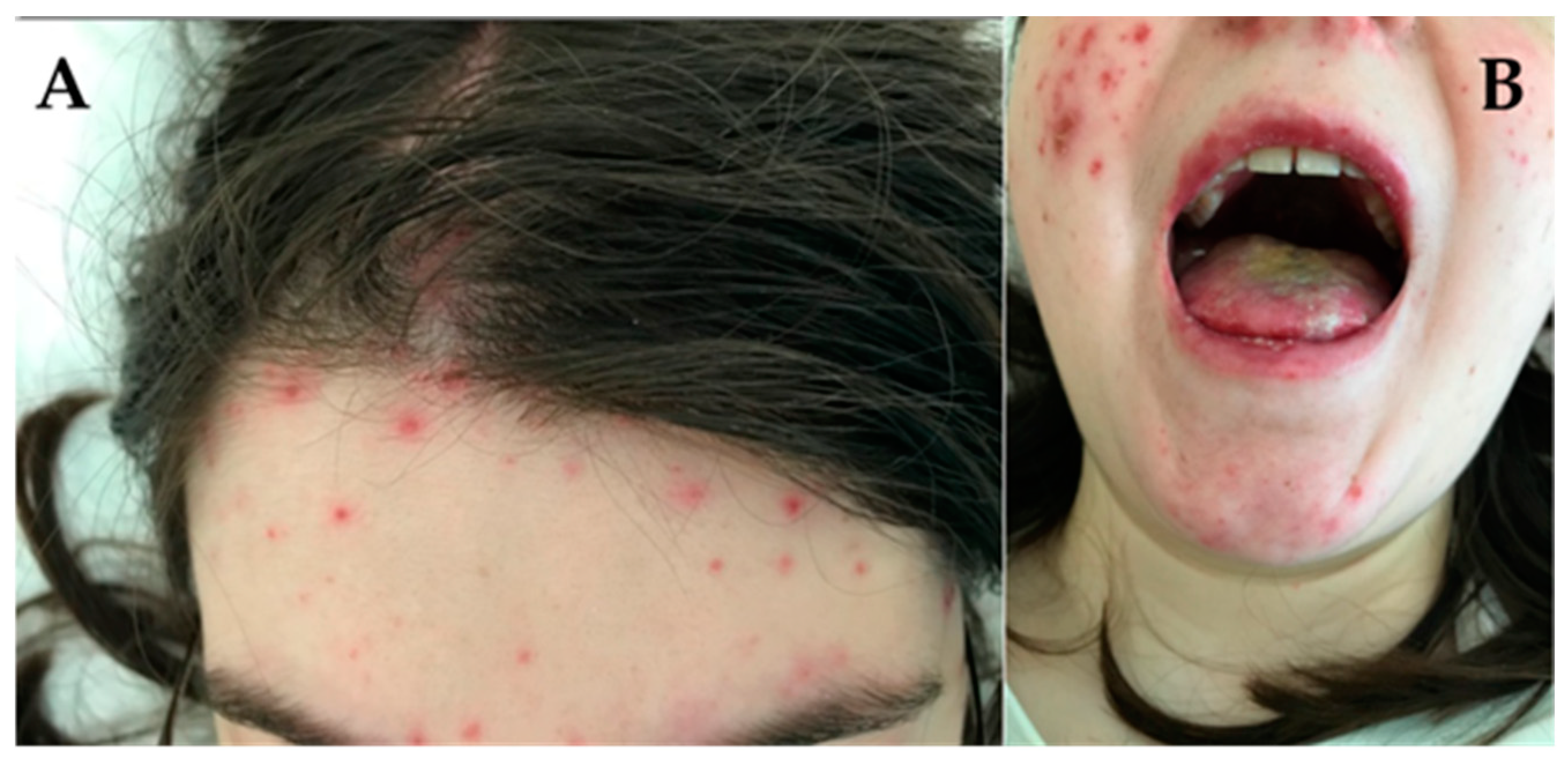 Amazon.co.jp: 〈洋書〉皮膚エリテマトーデス Cutaneous Lupus