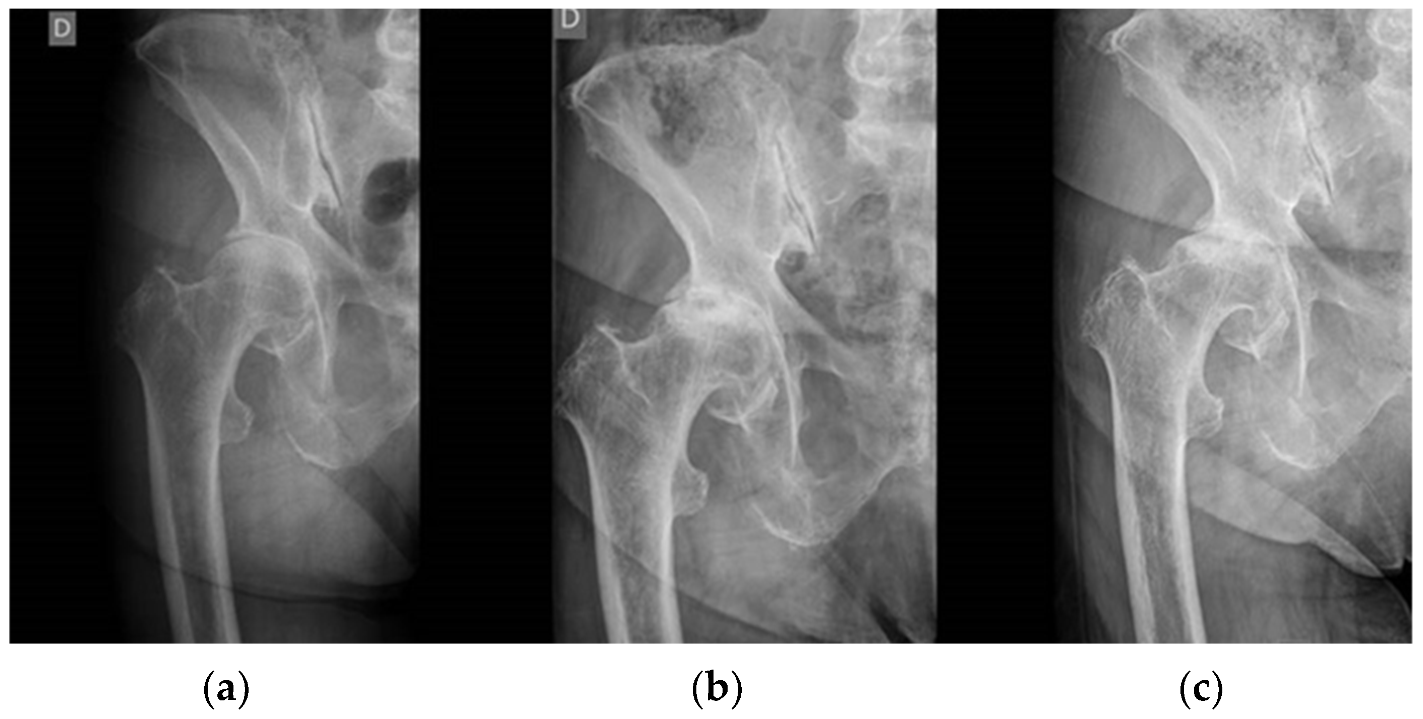 Rapidly Progressive Osteoarthritis of the Hip: A Prospective