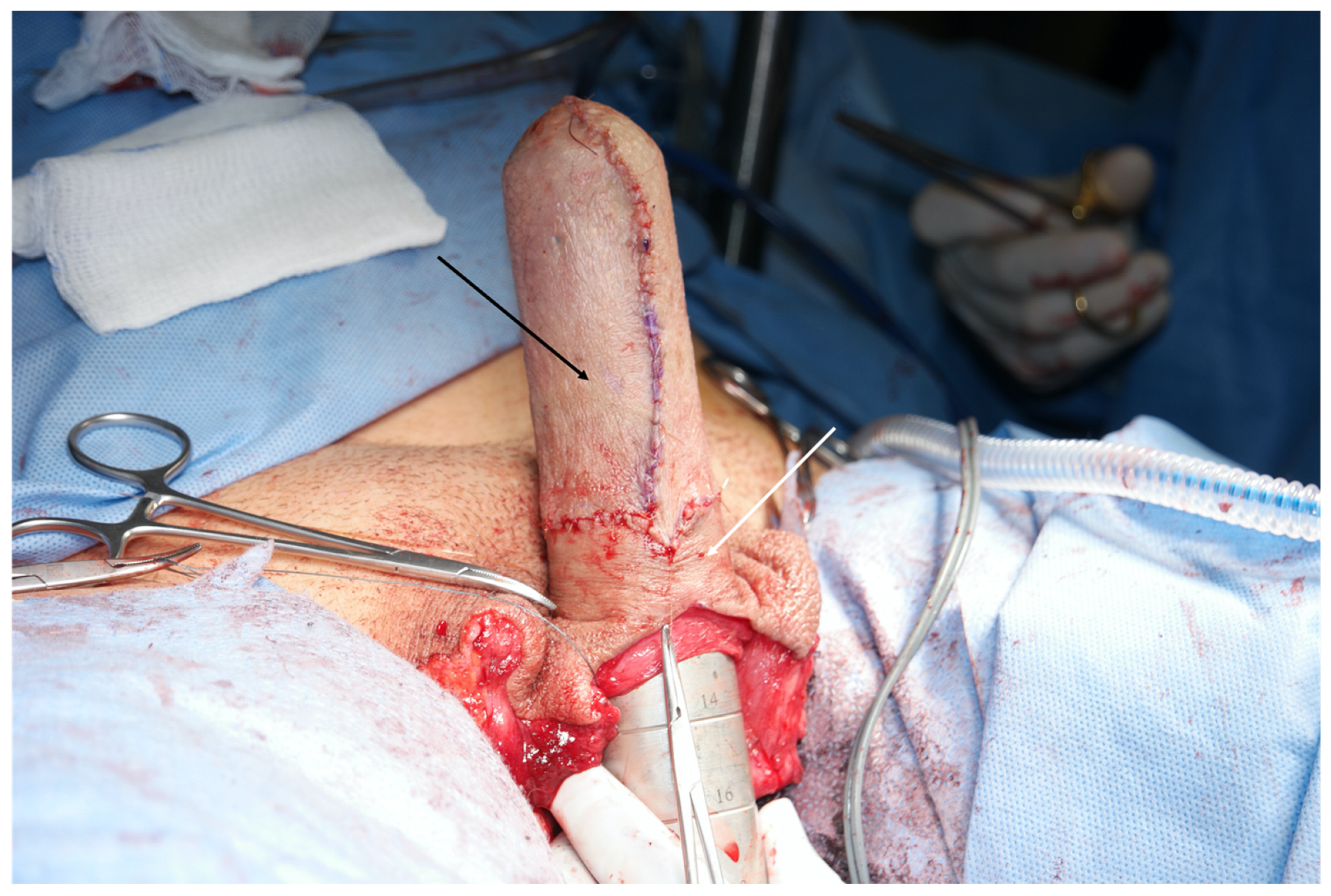trans gender operasion Tissue Options for Construction of the Neovaginal Canal in Gender-Affirming  Vaginoplasty