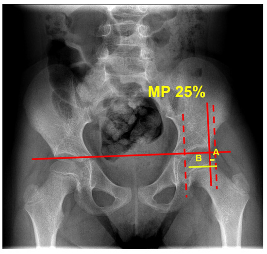 健康・医学 Occlusion Treating Aortoiliac Occlusive Disease (AOID): Aortic