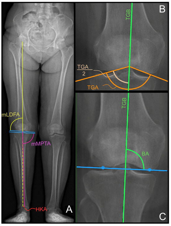 Trochlear Latera Radiograph The Trochlear Bisector as a New Landmark for Kinematic Alignment in ...