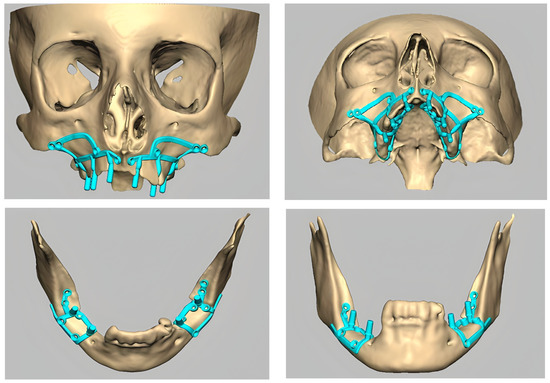 The Evolution of Custom Subperiosteal Implants for Treatment of