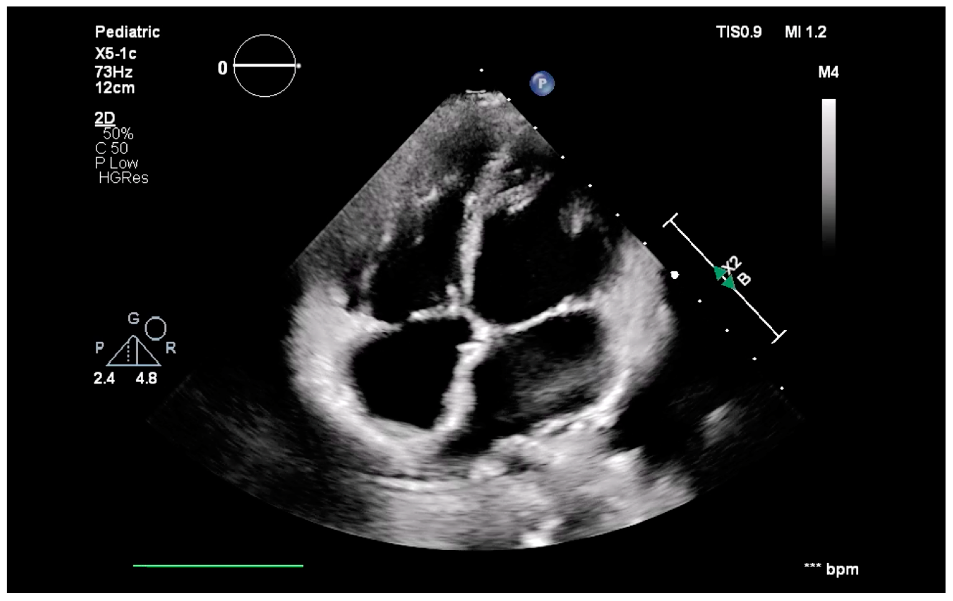 Raghib Syndrome and Pulmonary Arterial Hypertension in a