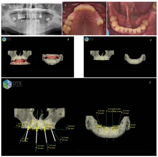 Three-Year Outcome of Full-Arch Fixed Prosthetic