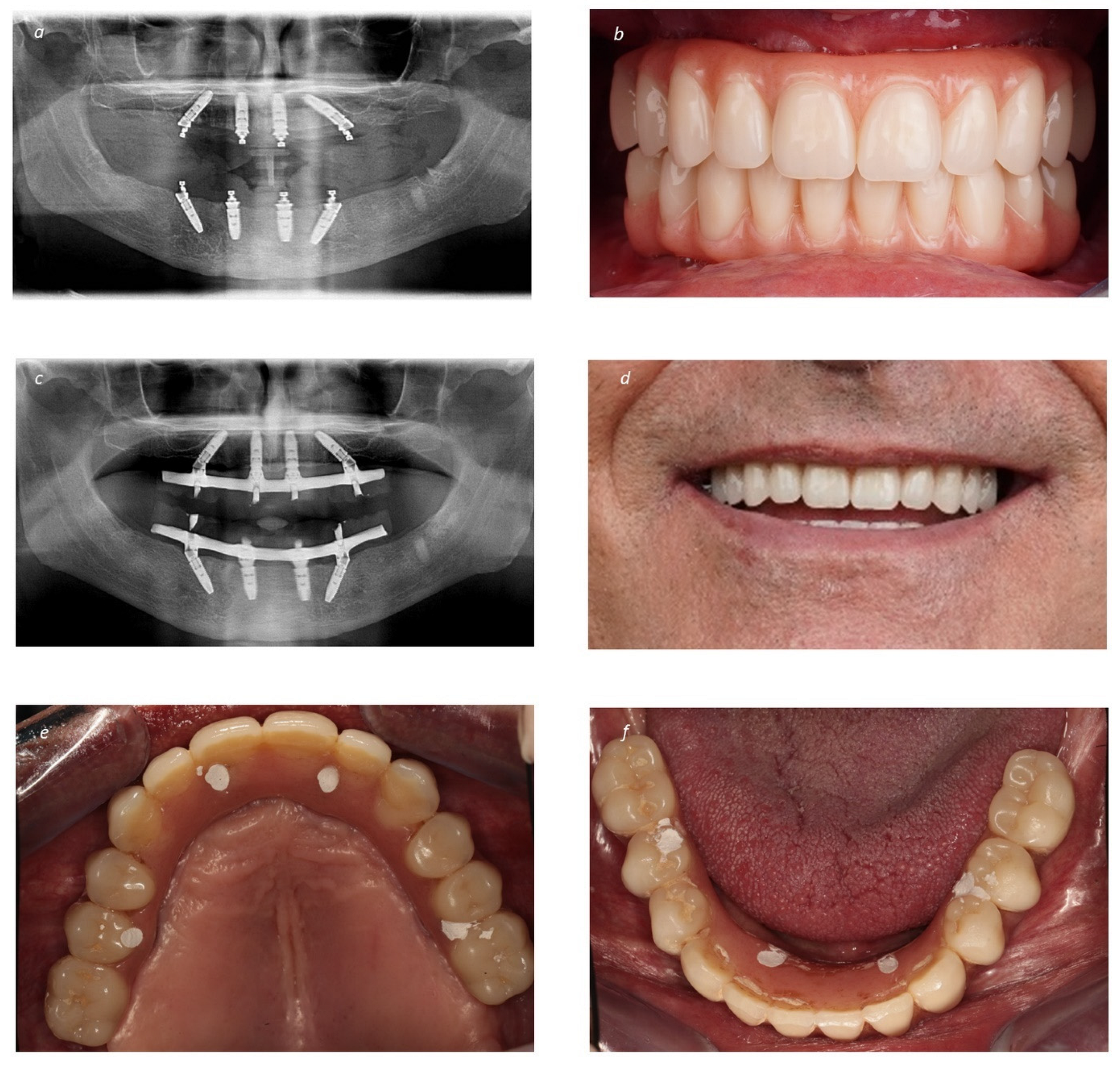 健康・医学 216 IMPLANTS Ultimate guide The Ultimate Guide To Dental Implants | Published