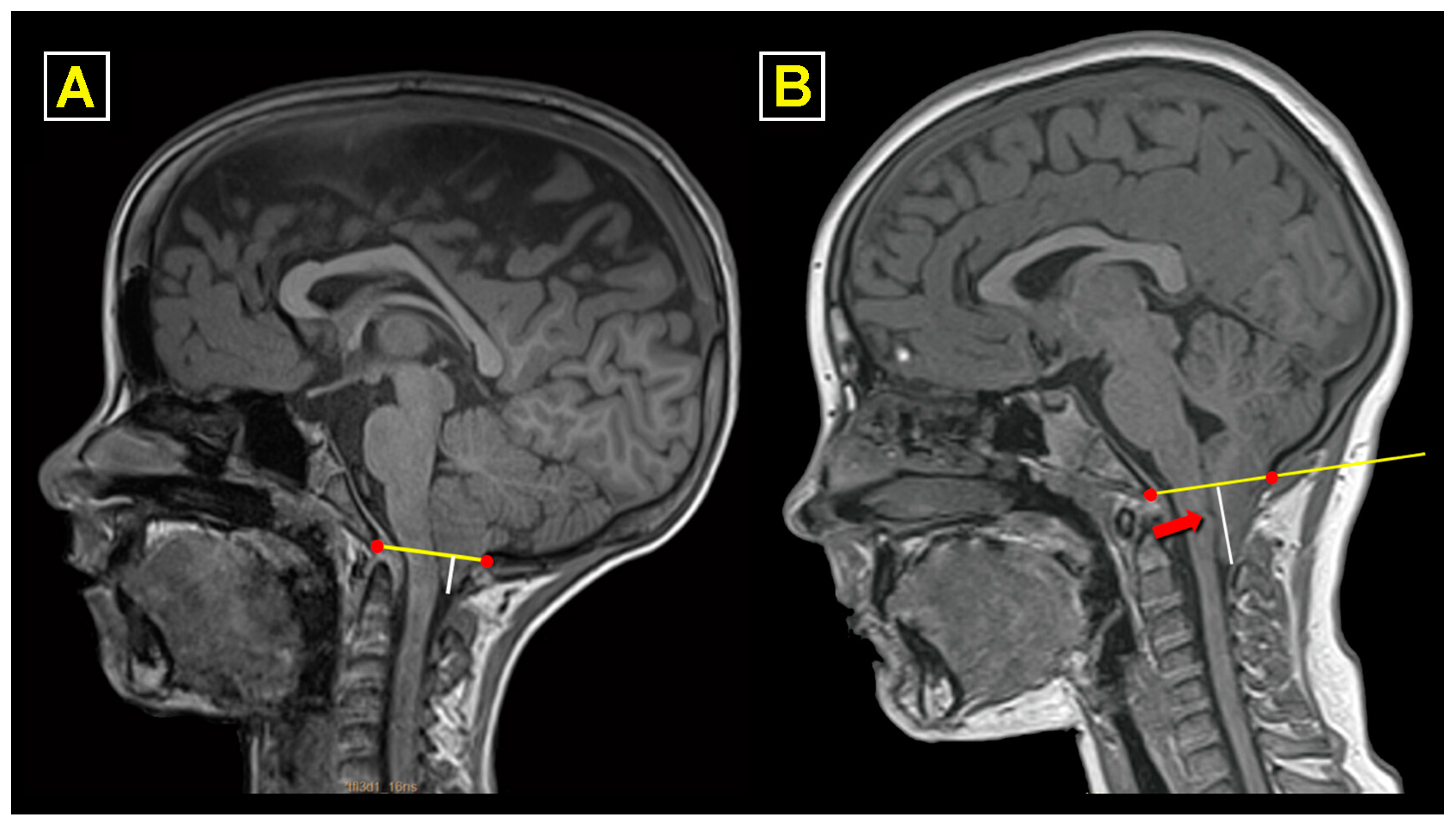 JCM Free FullText Surgical in Chiari 1 and Chiari 1.5 Malformation Treated by