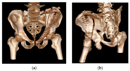 Clinical Workflow Algorithm for Preoperative Planning, Reduction