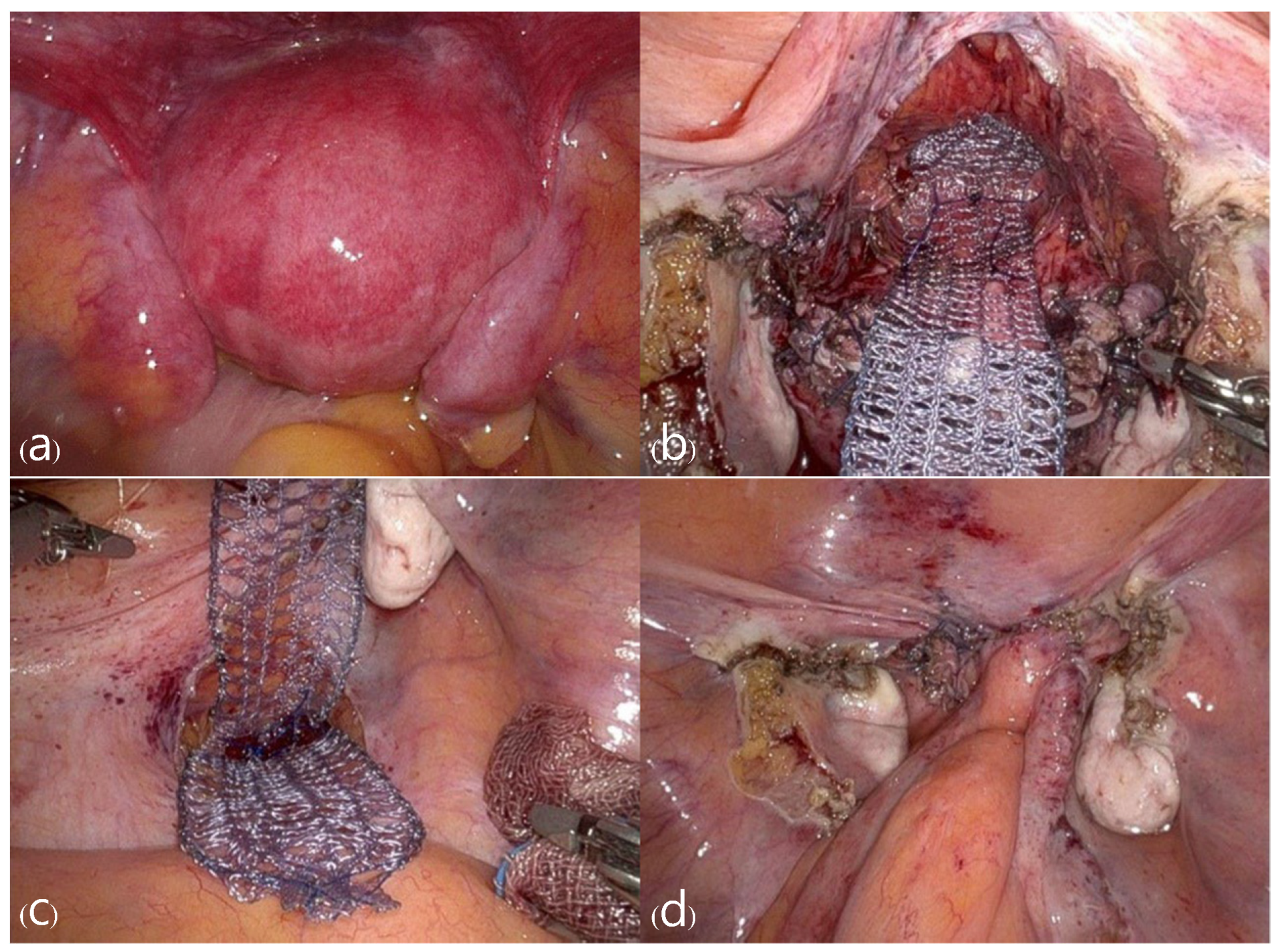 prolapse 