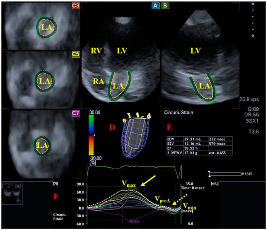Myocardial Mechanics and Valvular and Vascular Abnormalities Myocardial Mechanics and Valvular and Vascular Abnormalities