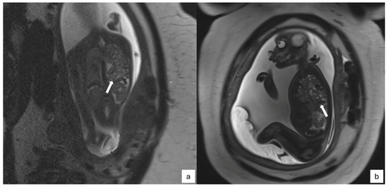 The New Frontiers of Fetal Imaging: MRI Insights into
